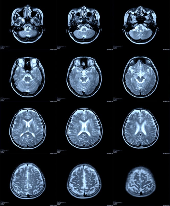 Brain MRI Scan Imaging